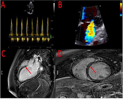 Use of Cardiac Contractility Modulation as Bridge to Transplant in an Obese Patient With Advanced Heart Failure: A Case Report